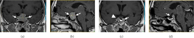 Thyroid-Stimulating Hormone-Secreting Pituitary Adenoma: Two Cases With Challenging Diagnosis and Management.
