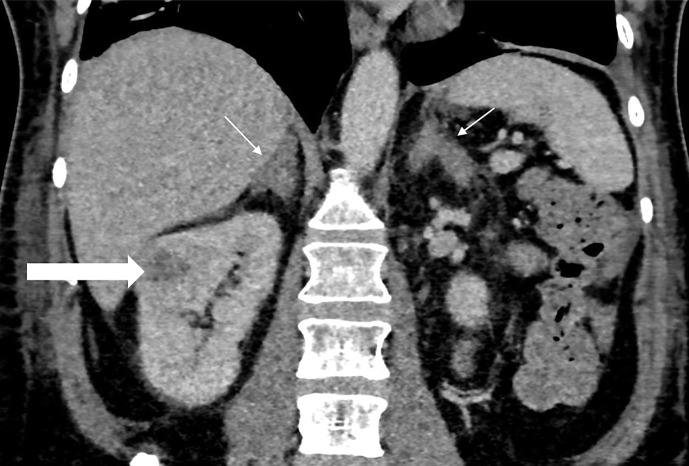 Cushing's Syndrome due to a Renal Neuroendocrine Tumor: A Case Report.