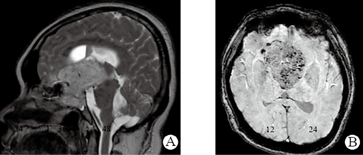 Successful Pregnancy in Woman With Hyperprolactinemia Associated With Hemorrhagic Giant Craniopharyngioma.