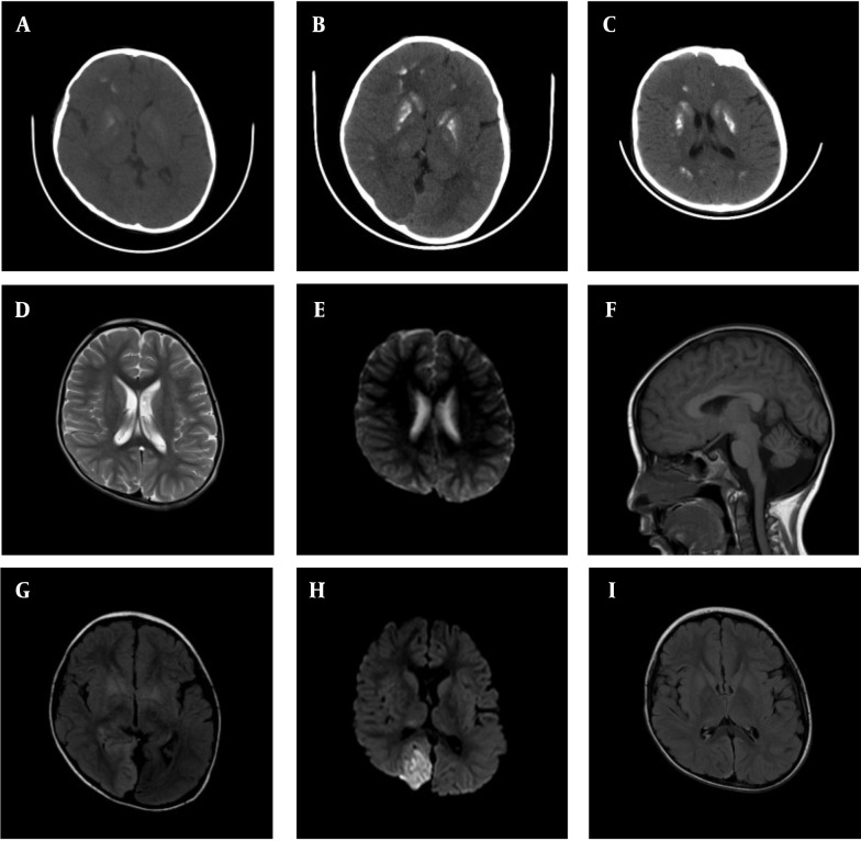 Hypoparathyroidism in a Child with MELAS Syndrome: A Case Report of Severe Lactic Acidosis and Symmetrical Bilateral Basal Ganglia Calcification.