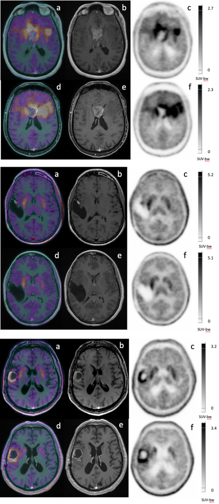 PET-based response assessment criteria for diffuse gliomas (PET RANO 1.0): methodological application in [<sup>18</sup>F]-FDOPA PET imaging.