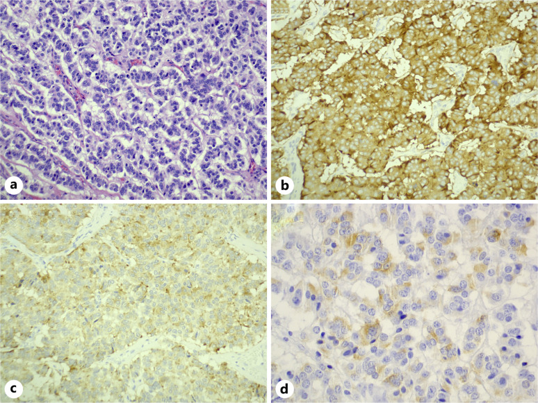 Cushing's Syndrome due to a Renal Neuroendocrine Tumor: A Case Report.
