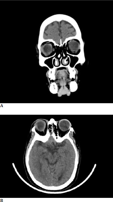 Ibandronic Acid Induced Orbital Inflammation and Concurrent Anterior Uveitis - A Rare Presentation.