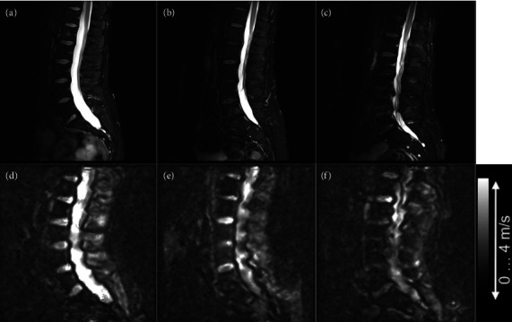 Assessing Intervertebral Disk Tissue Mechanics Using Dual-Actuator Multifrequency Magnetic Resonance Elastography: Case Reports.