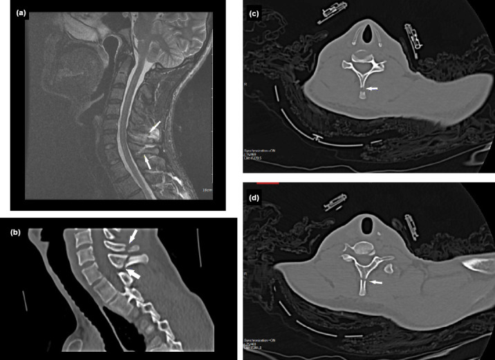 Traumatic isolated spinous process fractures.