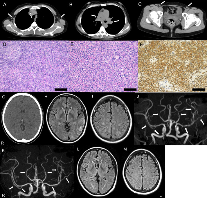 Reversible cerebral vasoconstriction syndrome in idiopathic multicentric Castleman disease under treatment with tocilizumab.
