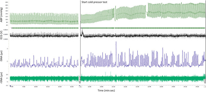 Sympathetic nerve activity and response to physiological stress in Takotsubo syndrome.