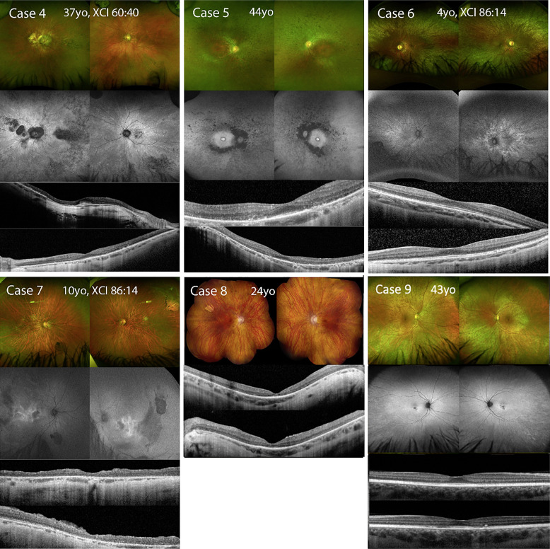 Female Simplex Carriers of X-Linked Retinal Dystrophies: A Case Series.