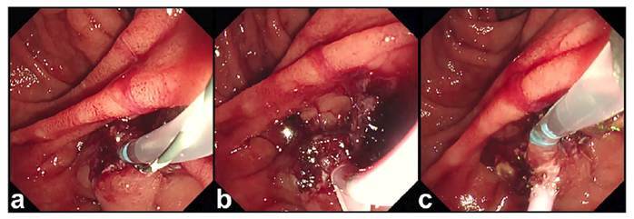 APPLICATION OF A TWO-COAT SELF-ASSEMBLING PEPTIDE HEMOSTATIC GEL TECHNIQUE IN MANAGING ENDOSCOPIC SPHINCTEROTOMY-RELATED BLEEDING: A CASE REPORT.