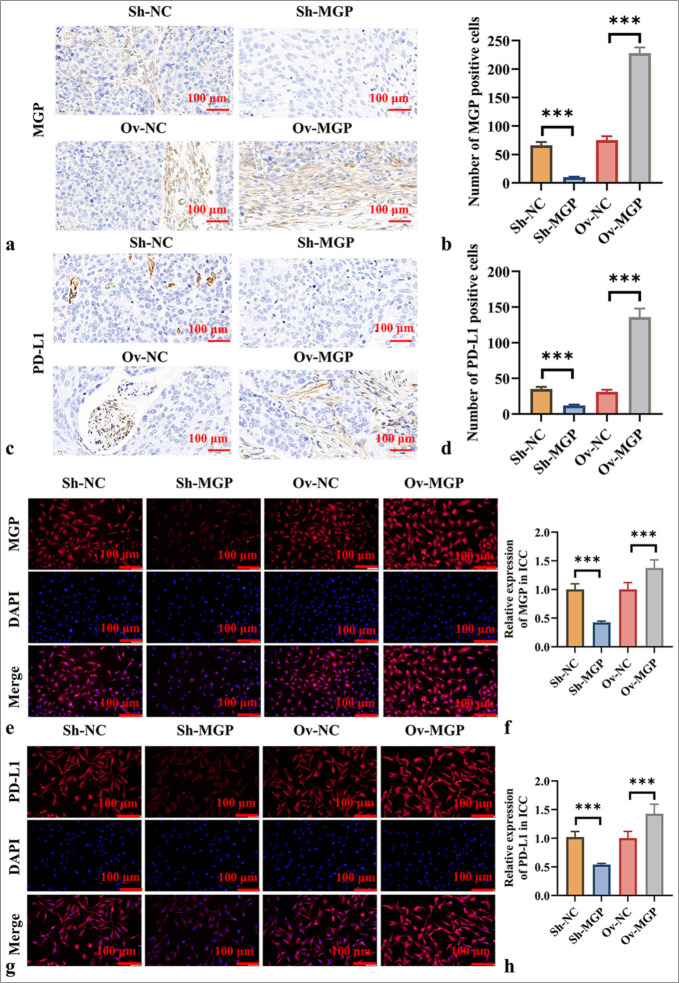 Matrix gla protein mediates CD8<sup>+</sup> T-cell exhaustion to facilitate immune evasion in intrahepatic cholangiocarcinoma.