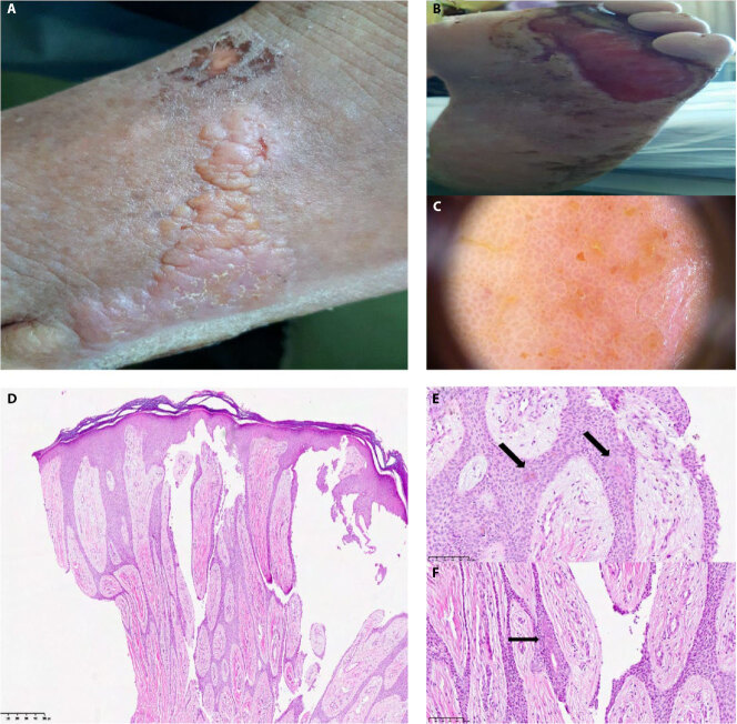 Reactive Eccrine Syringofibroadenoma Associated with Neuropathy and Diabetic Foot Ulcer.