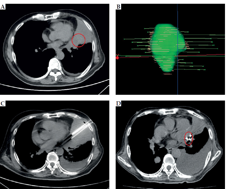 Evaluation of risk factors for difficult-to-control pain (VAS score > 3) at two months after late-stage non-small cell lung cancer treatment with iodine-125 radioactive particle implantation combined with chemotherapy.