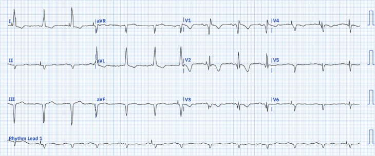 Left Septal Fascicular Block Following Left Bundle Branch Area Pacing.