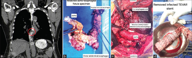 Aortoesophageal Fistula Following Thoracic Endovascular Aortic Repair.