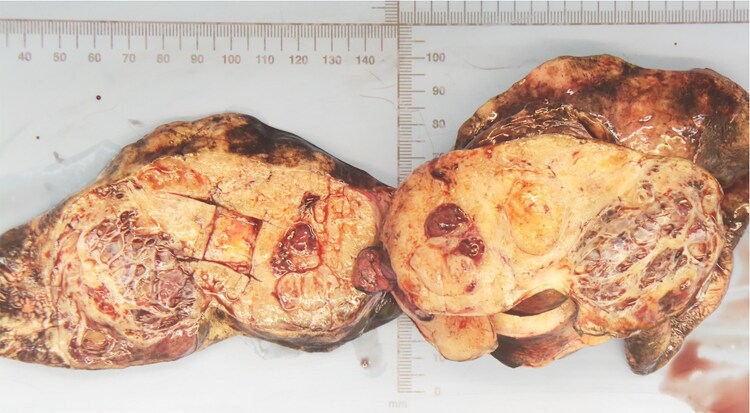 Hypertension and Carcinoid Heart Disease as Initial Manifestations of Ovarian Carcinoid Tumor.