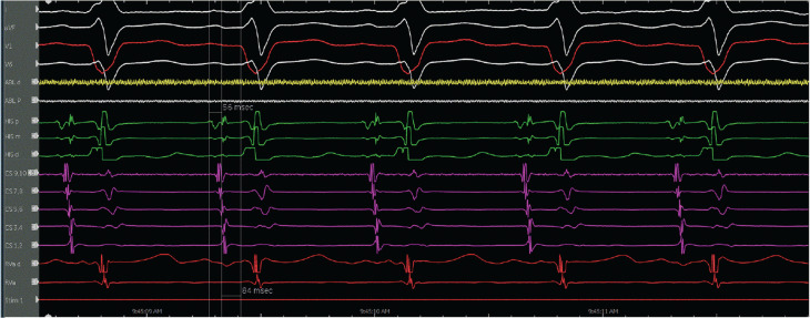 Dual-morphology Bundle Branch Re-entrant Ventricular Tachycardia in Non-dilated Cardiomyopathy.