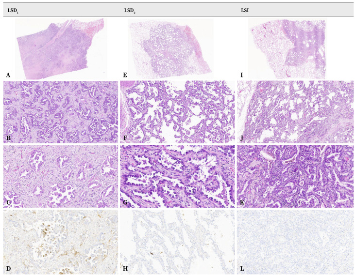 [Triple synchronous primary lung adenocarcinoma: A diagnostic challenge].