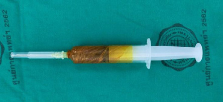 Evaluation of the Role of PRP in Acute Tibial Shaft Fractures Fixation With IM Nail: A Double-Blinded Randomized Controlled Trial.
