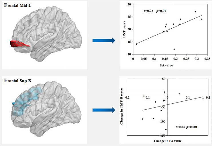 Transcranial Magnetic Stimulation Induces White Matter Microstructure Alterations in Patients with Mild Cognitive Impairment.