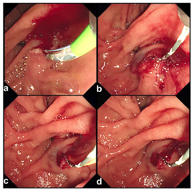 APPLICATION OF A TWO-COAT SELF-ASSEMBLING PEPTIDE HEMOSTATIC GEL TECHNIQUE IN MANAGING ENDOSCOPIC SPHINCTEROTOMY-RELATED BLEEDING: A CASE REPORT.