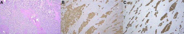 Hypertension and Carcinoid Heart Disease as Initial Manifestations of Ovarian Carcinoid Tumor.