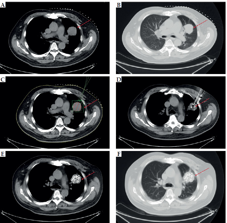 Evaluation of risk factors for difficult-to-control pain (VAS score > 3) at two months after late-stage non-small cell lung cancer treatment with iodine-125 radioactive particle implantation combined with chemotherapy.