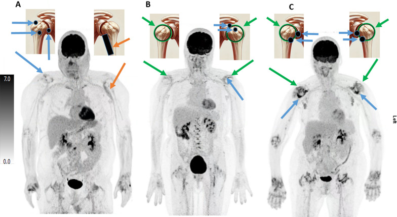 Whole-body and site specific [<sup>18</sup>F]FDG uptake patterns on PET/CT have limited value in differentiating between polymyalgia rheumatica and other inflammatory diseases: two cohorts of treatment-naïve suspected polymyalgia rheumatica.
