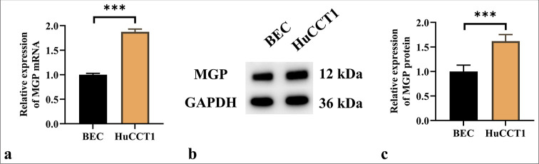 Matrix gla protein mediates CD8<sup>+</sup> T-cell exhaustion to facilitate immune evasion in intrahepatic cholangiocarcinoma.