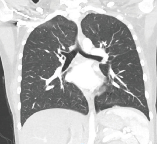 Insidious Primary Mediastinal Large B-Cell Lymphoma in a Young Female: A Case Report and Literature Review.