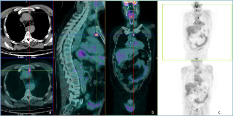 Cholesterol granuloma. Another brick in the wall of mediastinal lesions.