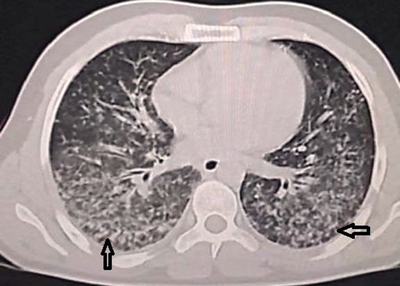 Varicella Pneumonia with Deep Venous Thrombosis and Pulmonary Embolism as Rare Presentations for Male: Case Report.