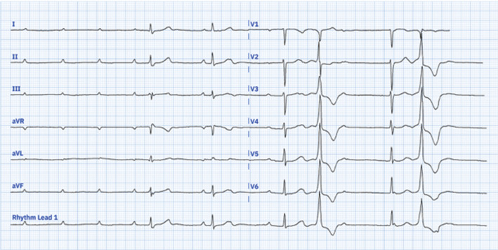 Left Septal Fascicular Block Following Left Bundle Branch Area Pacing.