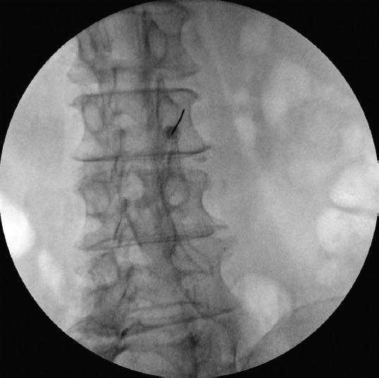 Does the severity of facet joint osteoarthritis affect facet medial branch radiofrequency thermocoagulation results?