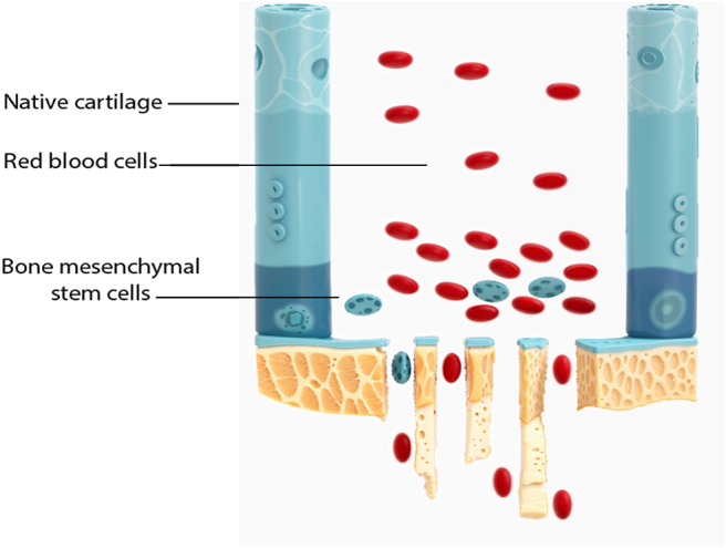 Current trends in the treatment of focal cartilage lesions: a comprehensive review.