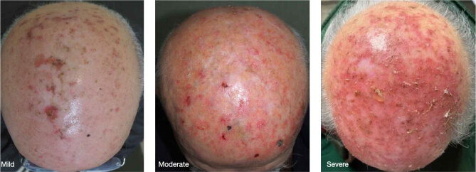 Management of Local Skin Reactions Caused by 5-FU 4% Cream for the Treatment of Actinic Keratosis: A Delphi Consensus.