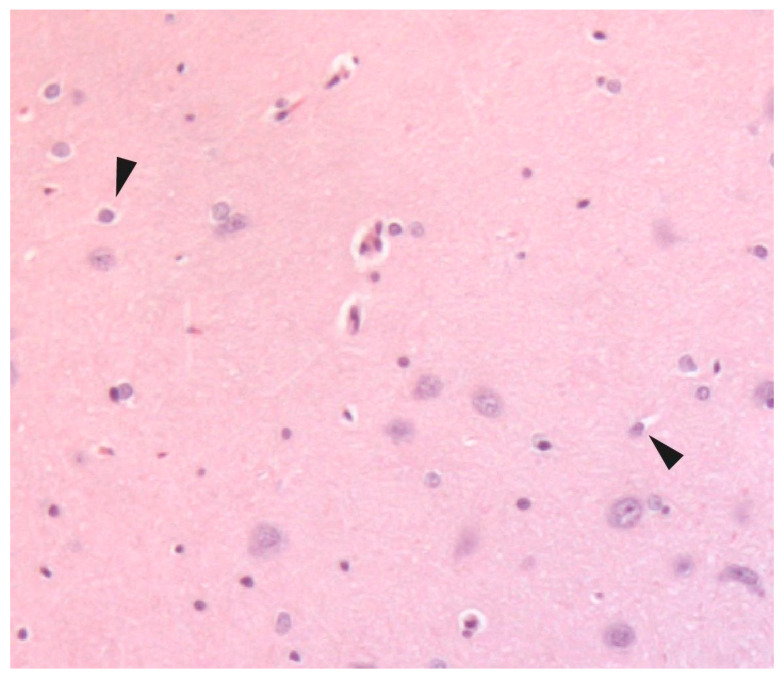 Effect of Cilostazol and Aspirin During Hyperacute Stroke Phase in Rats: An Experimental Research Study.