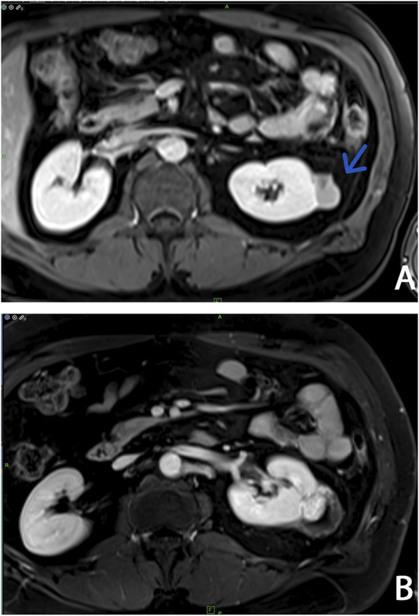 Timely recognition of a probably life-threatening genodermatosis: familial case report of hereditary leiomyomatosis and renal cell cancer.