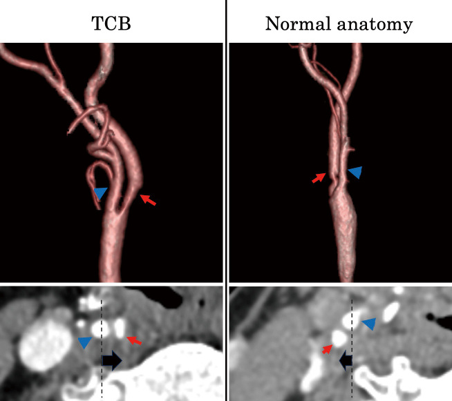 Surgical Outcomes of Carotid Endarterectomy in Patients with Twisted Carotid Bifurcation: Focus on Postoperative Nerve Complications.
