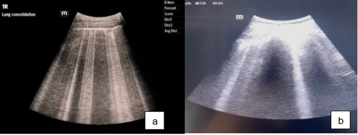 The diagnostic performance of automatic B-lines detection for evaluating pulmonary edema in the emergency department among novice point-of-care ultrasound practitioners.