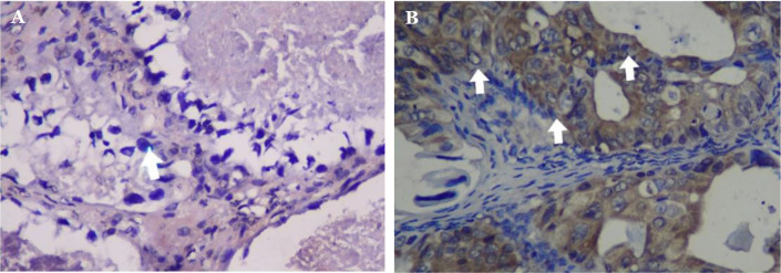 Comparison of PD-L1, CTR-1, VEGF, and p53 expression in sensitive and resistant epithelial ovarian cancer (EOC) patients to platinum-based chemotherapy.