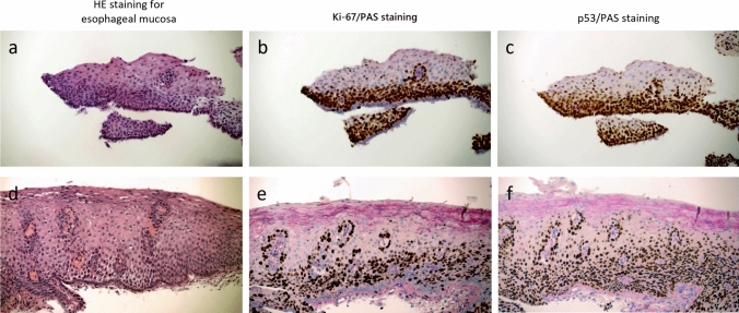p53 and Ki-67 combined with periodic acid-Schiff staining for the diagnosis of early stage esophageal squamous cell carcinoma lesions in biopsy specimens.