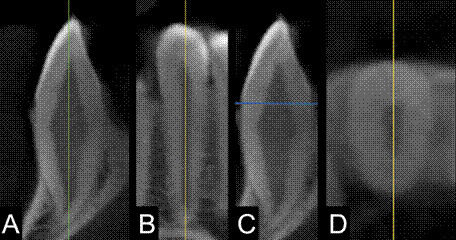 Sex estimation accuracy through metric evaluation of dental root: a cone-beam computed tomography-based study.