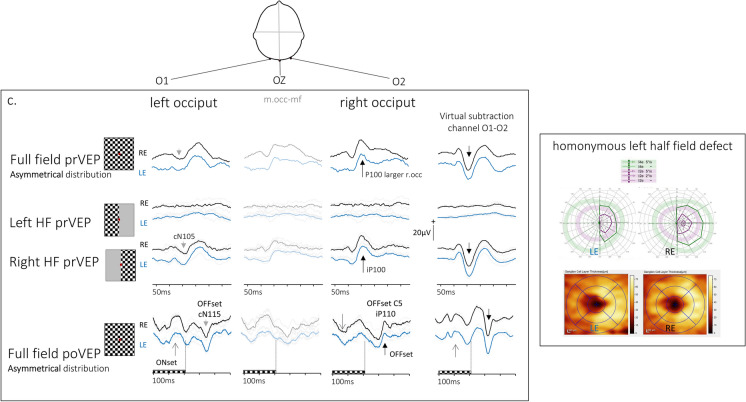 Multi-channel pattern VEPs with full and half field stimulation: methods of interpretation and diagnostic evaluation.