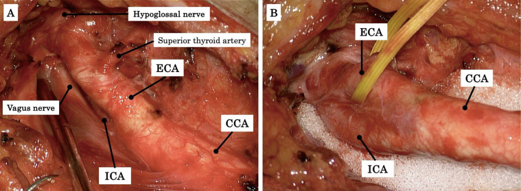 Surgical Outcomes of Carotid Endarterectomy in Patients with Twisted Carotid Bifurcation: Focus on Postoperative Nerve Complications.
