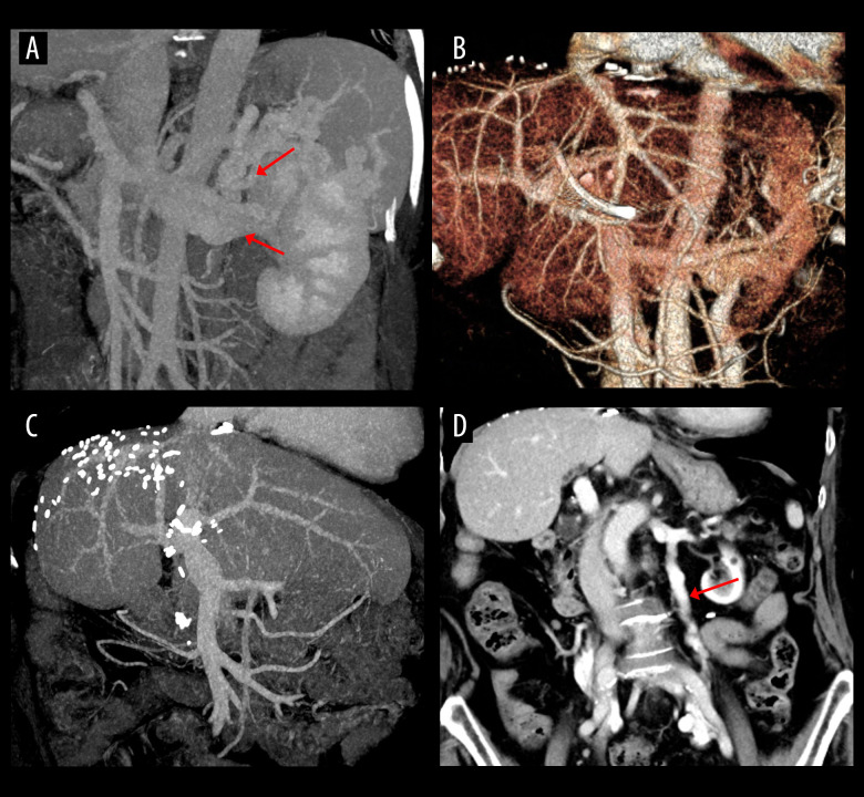 Long-Term Outcomes of Left Renal Vein Ligation in Living Donor Liver Transplantation: A 20-Year Study.