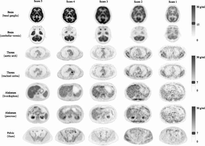 A fully automated, expert-perceptive image quality assessment system for whole-body [18F]FDG PET/CT.
