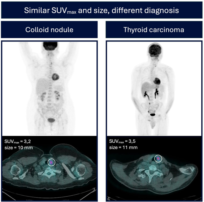 AI may help to predict thyroid nodule malignancy based on radiomics features from [<sup>18</sup>F]FDG PET/CT.