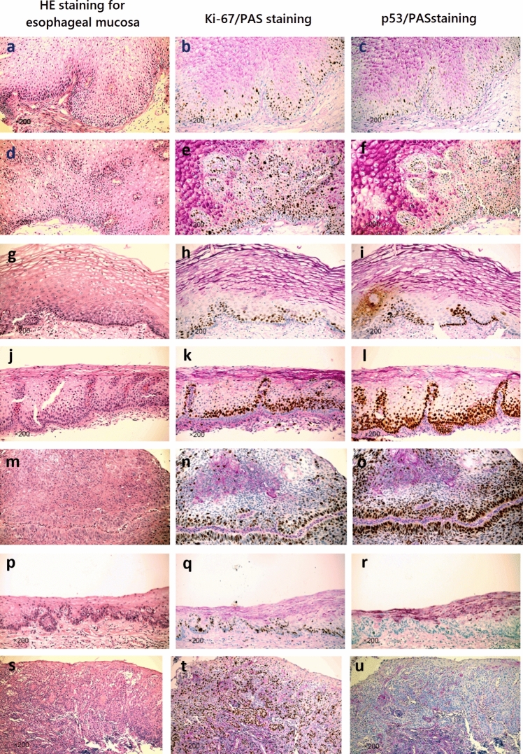 p53 and Ki-67 combined with periodic acid-Schiff staining for the diagnosis of early stage esophageal squamous cell carcinoma lesions in biopsy specimens.