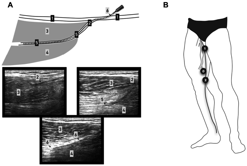 Thigh muscle pump function during ambulation