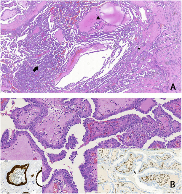 Timely recognition of a probably life-threatening genodermatosis: familial case report of hereditary leiomyomatosis and renal cell cancer.